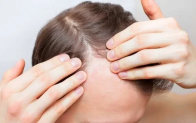 Tipos de alopecia, ¿cuál es la mía?