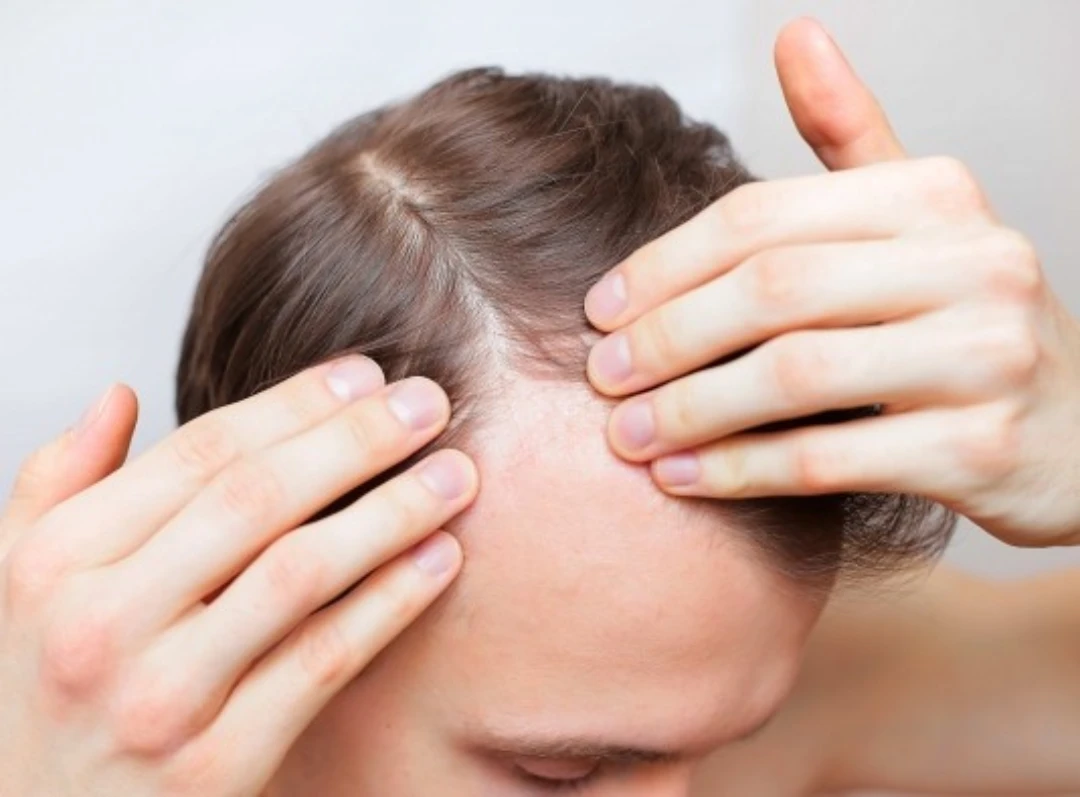 Tipos-de-alopecia-androgenetica-areata-difusa-cicatricial_thumbnail