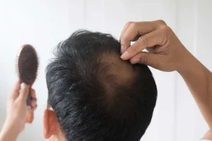 Alopecia androgenética o androgénica en hombre coronilla