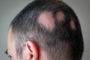 Alopecia areata