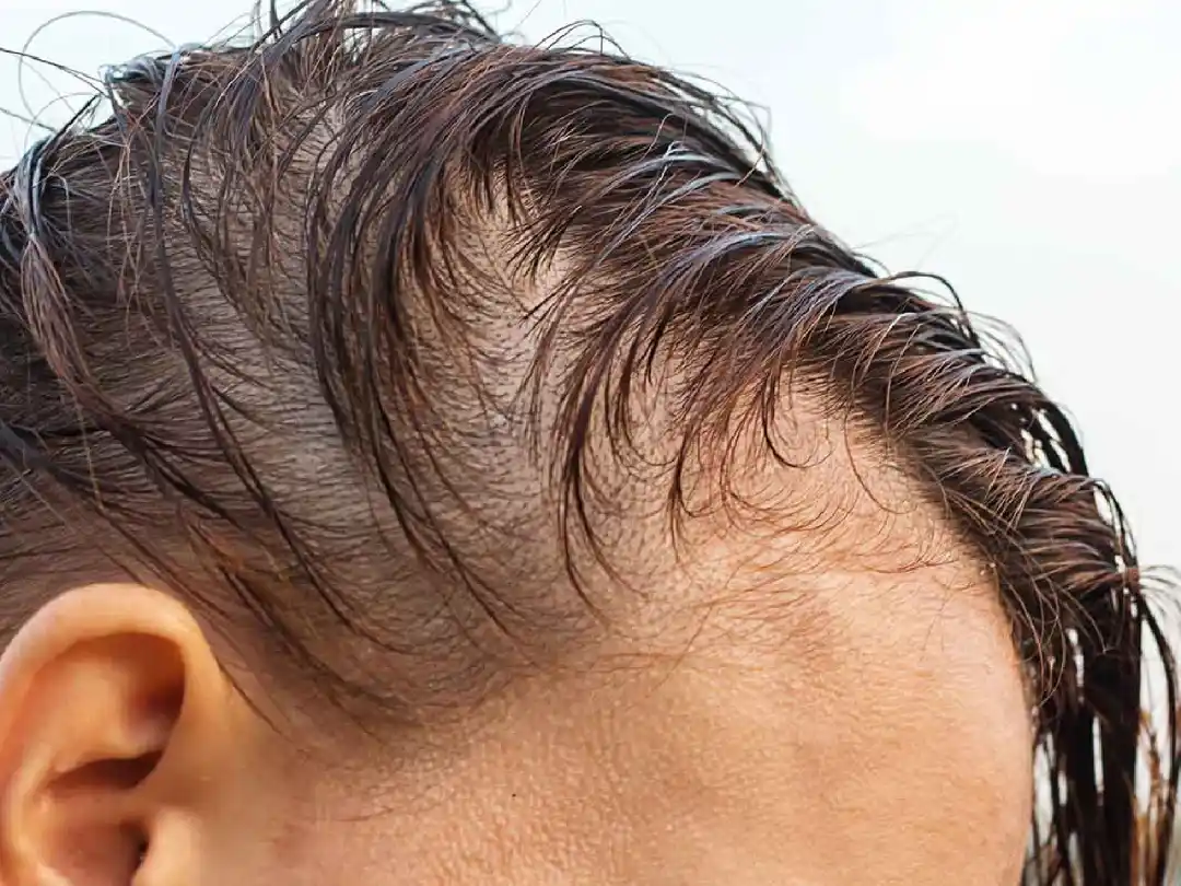 b2ap3_large_alopecia-difusa Alopecia difusa