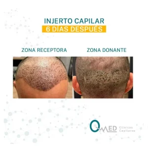 Costras en la zona donante tras injerto capilar
