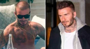 Trasplante capilar en famosos | David Beckham