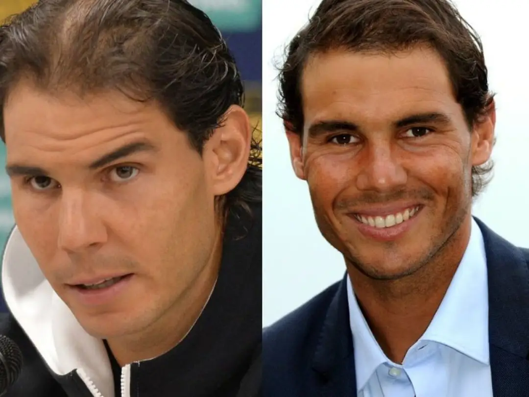 b2ap3_large_famosos-injerto-capilar-rafa-nadal famosos-injerto-capilar-rafa-nadal