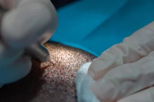 trasplante de pelo manual con técnica FUE