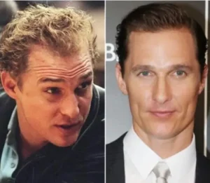 Trasplante capilar en famosos | Mathew MacConaughey