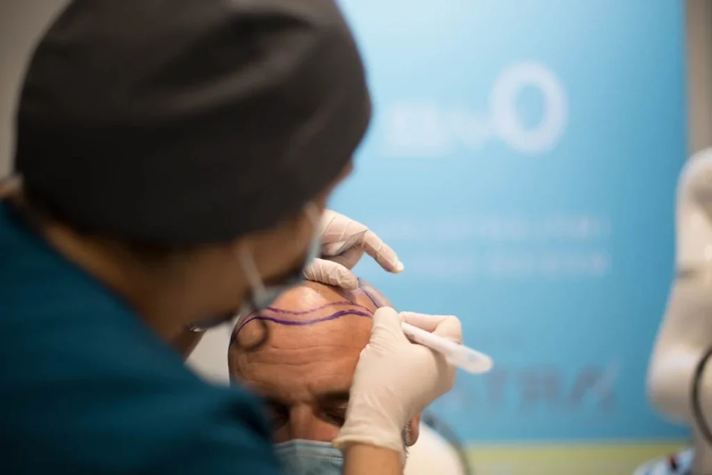 Claves para elegir la mejor clĂnica de injerto capilar | QMED