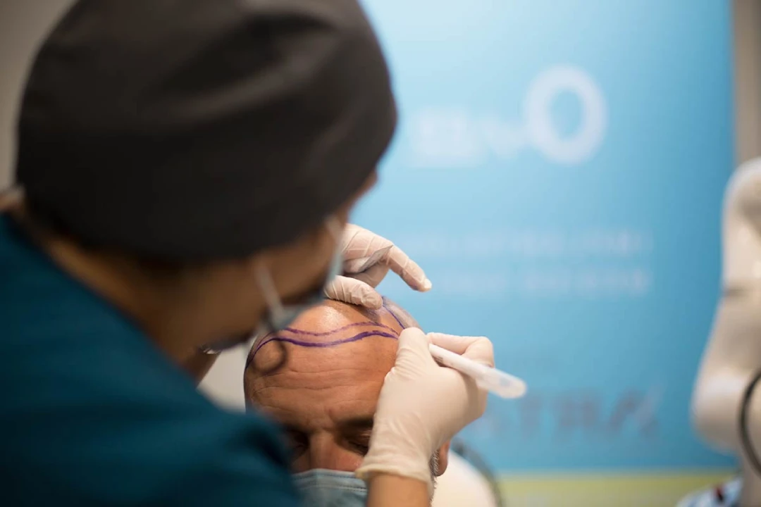 Claves para elegir la mejor clínica de injerto capilar | QMED