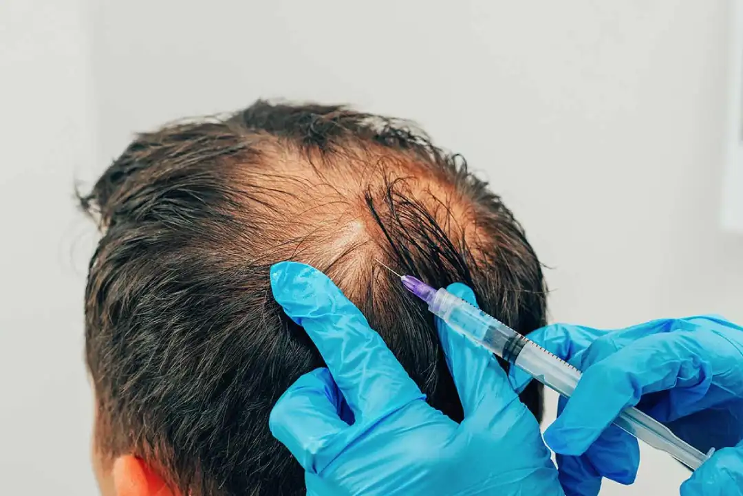 b2ap3_large_prp-injerto-capilar Beneficios del PRP o plasma rico en plaquetas combinado con injerto capilar | QMED, centros de injerto capilar y tratamientos capilares en España