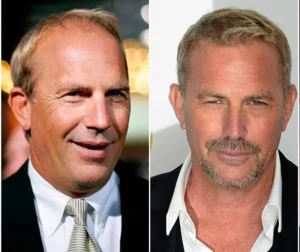 Trasplante capilar en famosos | Kevin Costner