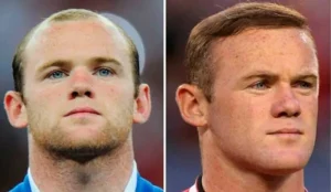 Trasplante capilar en famosos | Wayne Rooney