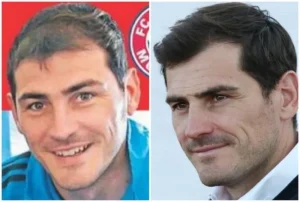 Famosos con injerto de pelo | Iker Casillas
