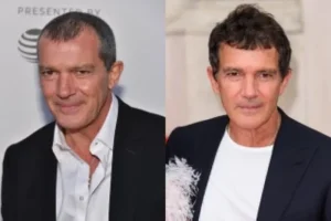 Famosos con injerto de pelo | Antonio Banderas