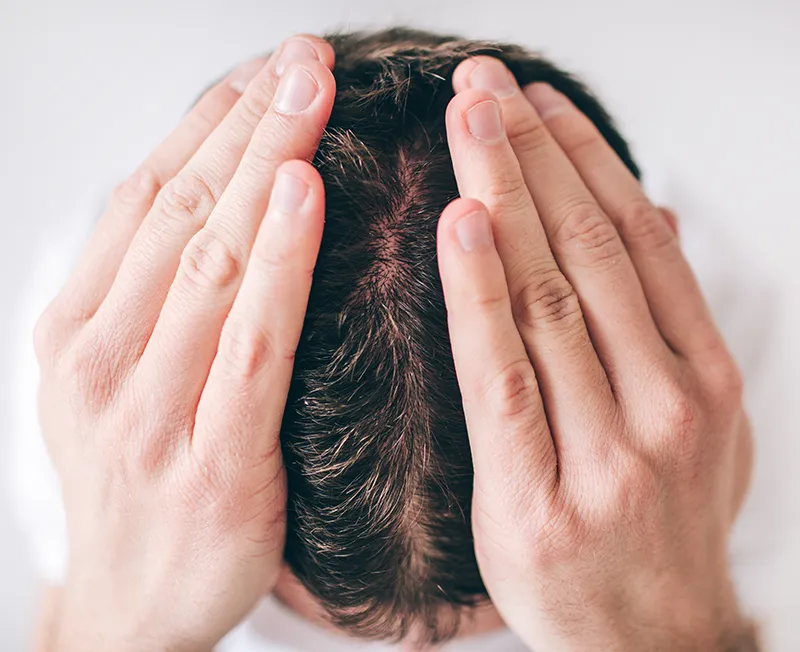 trasplante cabello implante capilar