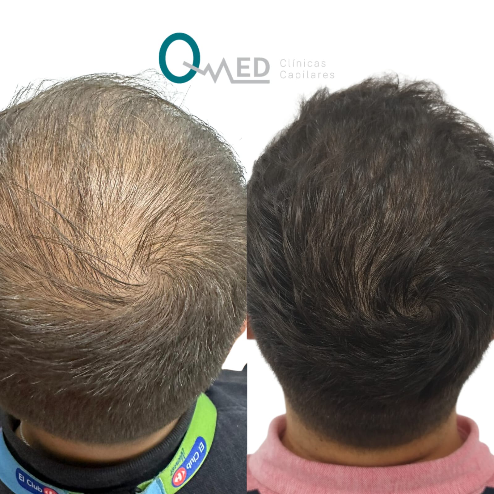 Foto de antes y después de un caso donde recupera densidad capilar.